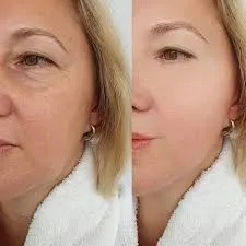 Profhilo®: cuando la ciencia natural redefine la calidad de la piel